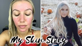 HOW I CURED MY ACNE ROSACEA BEFORE amp AFTER MY SKIN STORY REDNESS ACNE TREATMENT Scarlett London [upl. by Notserc]