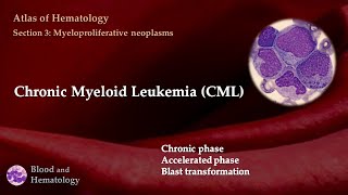 Chronic Myeloid Leukemia CML [upl. by Hadeis]