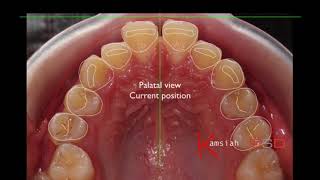 Digital Smile Design In Orthodontics [upl. by Aiyot]