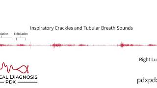 The Lung Sounds of Pneumonia [upl. by Ianahs]