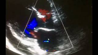 Ecocardiograma Complicaciones del Infarto al miocardio [upl. by Krissie]