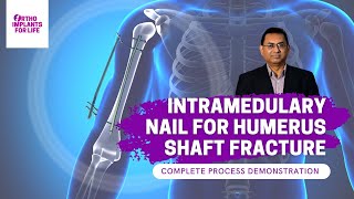 Intramedullary Nail For Humerus Shaft Fracture Procedure [upl. by Varin]