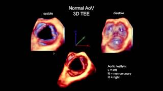 3D Echocardiography Acquisition Cropping and Case Examples [upl. by Akire]