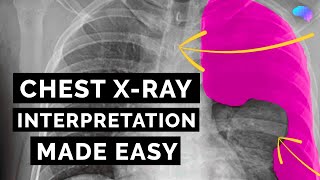 Chest Xray Interpretation  How to Read a CXR  OSCE Guide  UKMLA  CPSA [upl. by Ontina]