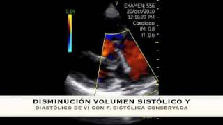 VSCAN Pulmonary Hypertension HIPERTENSION ARTERIAL PULMONAR [upl. by Subocaj]