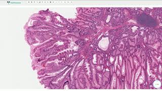 PeutzJeghers Polyp  Histopathology [upl. by Netsruk]