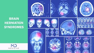 Brain Herniation syndromes Types Symptoms and Treatment [upl. by Ailugram]