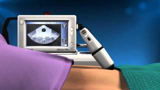 Cubescan BioCon700 Bladder Scanner  Reduce Urinary Tract Infections UTI [upl. by Onilatac]