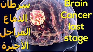 أعراض سرطان الدماغ فى مراحله الأخيرة  هل لديك إحداها ؟  Brain Cancer Symptoms [upl. by Ledoux]