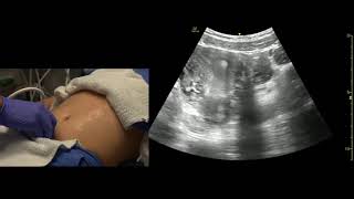 Transabdominal Pelvis Ultrasound Scanning Techniques [upl. by Ahsekal]