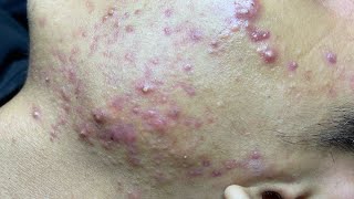 ACNE TREATMENT VU QUYNH MI  Blackheads On Boy Face 2024FULL [upl. by Gaal]