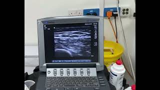 Scanning technique for adductor canal block [upl. by Ahsercel]