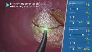 MOSES™ 20 Technology Holmium Laser for Lithotripsy Animation [upl. by Regen678]