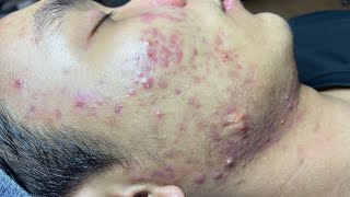 ACNE TREATMENT VU QUYNH MI Blackheads On Boy Face 2024 [upl. by Aneeram123]