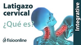 Latigazo cervical  ¿Qué es y cuáles son las claves de su solución [upl. by Hamlen]