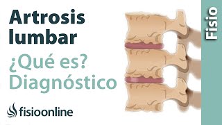 Artrosis lumbar  Qué es y cómo se diagnostica en radiografías [upl. by Eirrehc]