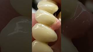 Zirconia bridge viralvideo dentist dentistworld dentalcare dentistryworld dentistry shorts [upl. by Kistner351]