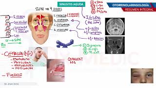 Otorrinolaringología  Sinusitis aguda [upl. by Olocin]