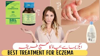 Eczema TreatmentHere is Homeopathic Solutions That Work [upl. by Taite]