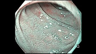 Celiac disease Endoscopic findings [upl. by Aydan]