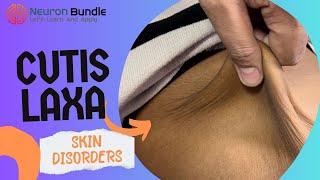 Cutis laxa  highly stretchable skin disorder connective tissue disorder  genetics [upl. by Euqinommod]