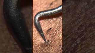 Ingrown hair plucking ASMR  tweezing bikini line [upl. by Chrysler]