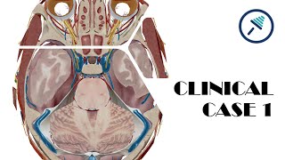 Brain herniations  Case 1 [upl. by As853]