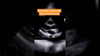 ANEURISMA DE LA ARTERIA AORTA ECOGRAFÍA ABDOMINAL [upl. by Anaek]