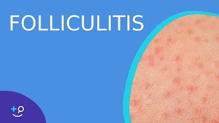 Folliculitis  Daily Dos of Dermatology [upl. by Jobe]