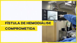 Angioplastia em fístula de hemodiálise [upl. by Talie]