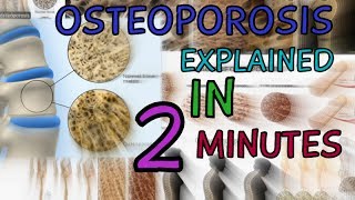 OSTEOPOROSIS  EXPLAINED IN 2 MINUTES  CAUSES  SYMPTOMS  TREATMENT  WHAT IS OSTEOPOROSIS [upl. by Odlabu]