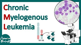 Chronic Myelogenous Leukemia CML  Pathology of CML  Diagnosis and treatment of CML  USMLE [upl. by Pickford]