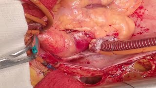 Extended Version I Reimplantation of the Aortic Valve in a Patient with LoeysDietz… Graphic [upl. by Ialohcin1]