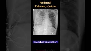 Unilateral Pulmonary Oedema Differential Diagnosis Radiology tutorials shorts [upl. by Nyrtak173]