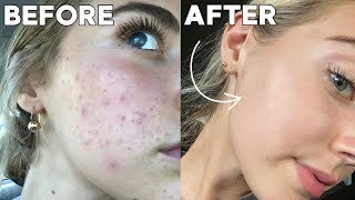 How I Cleared My Skin In 8 Weeks naturally [upl. by Aneleiram]