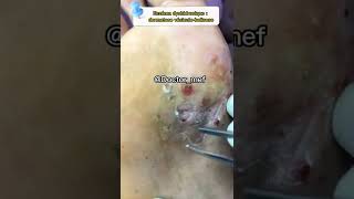 Dermatose vesiculobulleuse  Eczéma deshydrosique santé conseils infection [upl. by Hax]