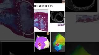 Cómo los Navegadores Tridimensionales Transforman el Tratamiento de Taquicardias Ventriculares [upl. by Meunier133]