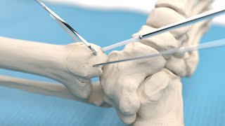 Medial malleolar osteotomy and talar osteochondral fragment fixation using Inion CompressOn™ screw [upl. by Notla321]