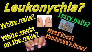 All about Leukonychia whitening of the nails [upl. by Areemas]