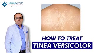 Tinea versicolor  Dr Rohit Batra  Tinea Versicolor Treatment  How to treat Tinea Versicolor [upl. by Goss593]