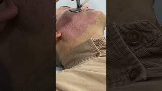 Erase Scars Fast with CO2 Fractional Laser Treatment shortvideo scarremoval [upl. by Zilber]