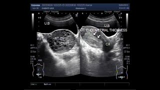 Endometrial Hyperplasia and Hemorrhagic Ovarian Cyst [upl. by Macario103]