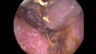 257  Dry Ear Wax Removal in Otitis Externa Ear  Mr Neel Raithatha The Hear Clinic [upl. by Kendyl136]