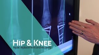 The Procedure  Osteotomy [upl. by Eetak]