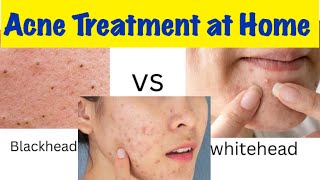 How to treat Pimple amp Acne at Home Blackhead amp Whitehead treatmentacne kasiy khatam karyDrHS [upl. by Corie136]