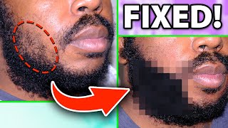 FUE Beard Hair Transplant 900 Grafts African American Man [upl. by Enaitsirk]