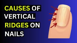 The Cause Of Vertical Ridges on Your Nails [upl. by Delly]