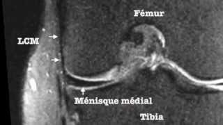 Plan Ligamentaire Médial interne du Genou [upl. by Hamlen]