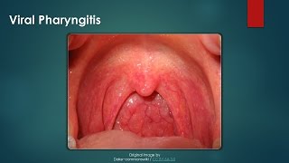 Pharyngitis  Symptoms causes and Treatment Streptococcal pharyngitis [upl. by Kama]