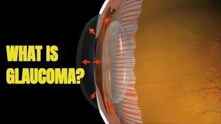 Glaucoma Signs and Treatment 3D Animation [upl. by Ahsieyk]